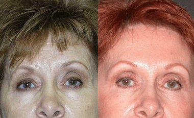 Forehead lift patient of Dr Fiala